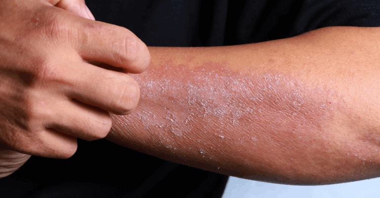 autoimmune disease stem cell help and therapy