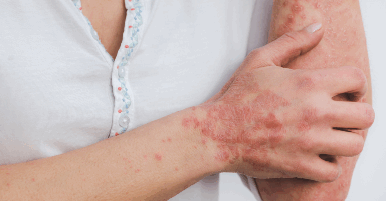 autoimmune diseases care stem cells