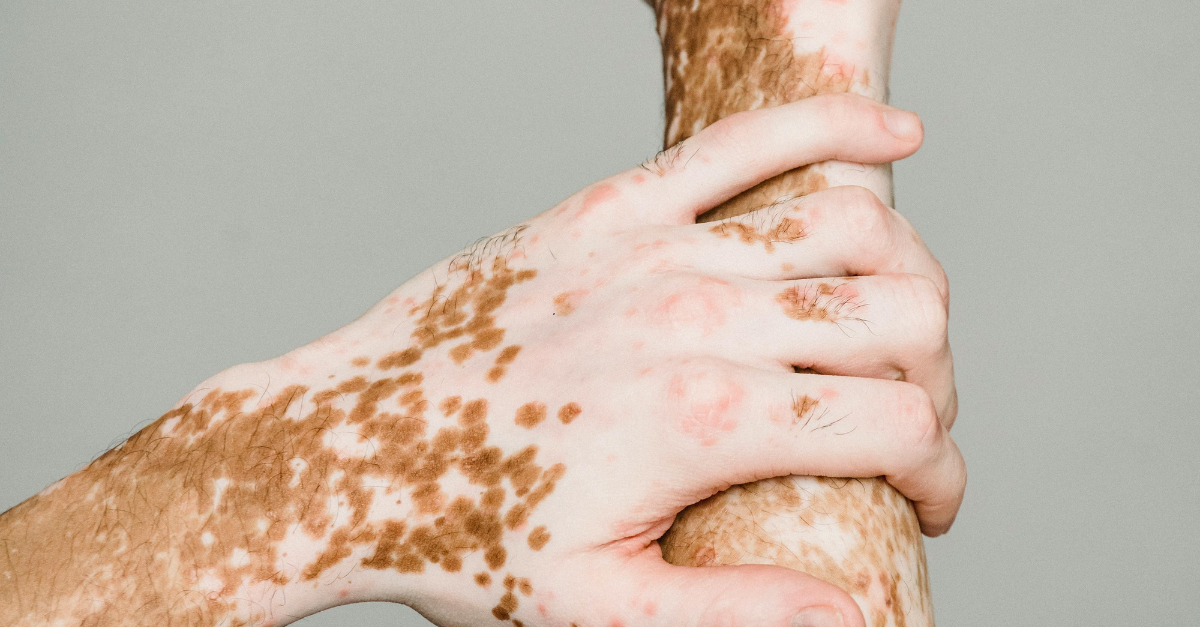 autoimmune care PCT