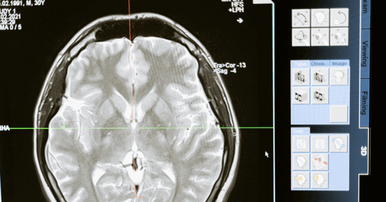 MSCs for Neuro Support