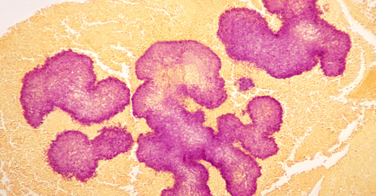 autoimmune well-being PCT