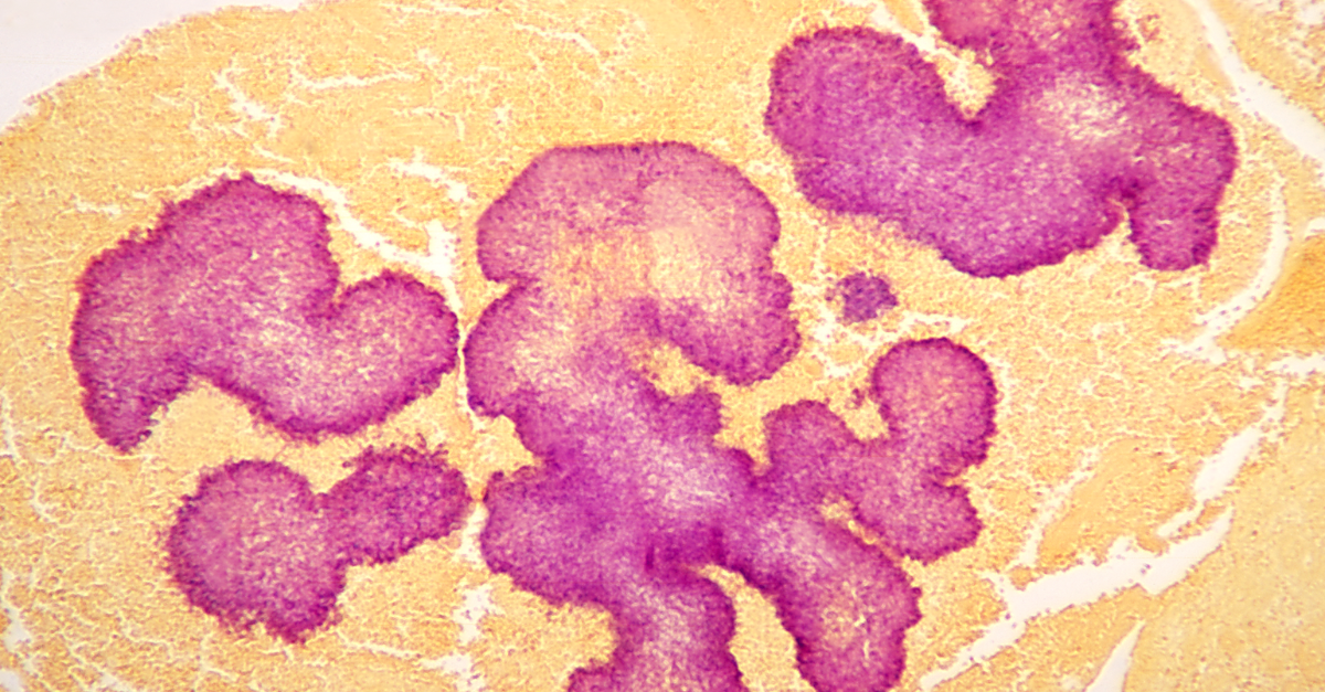 autoimmune well-being PCT