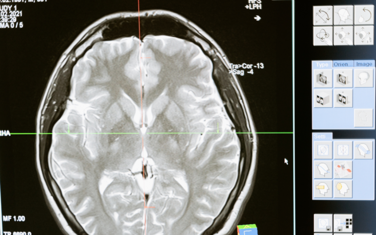 Neuro issues relief with PCT Panama Stem Cells