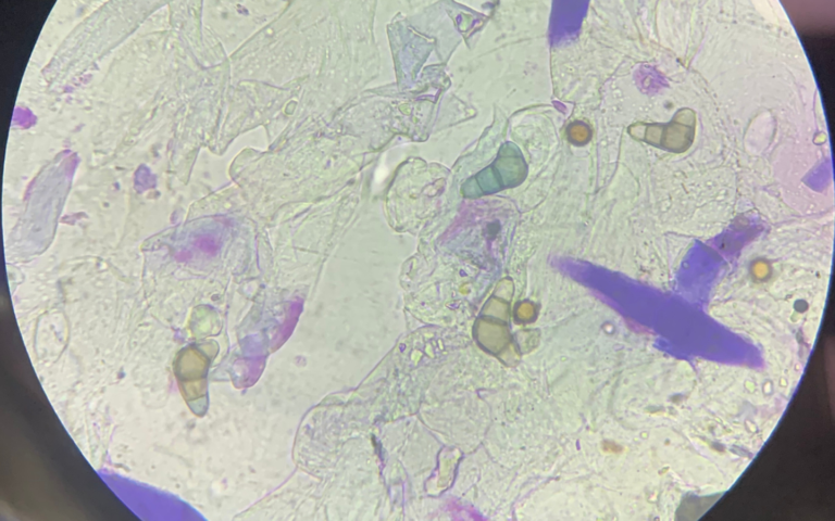 autoimmune issues resolution at PCT